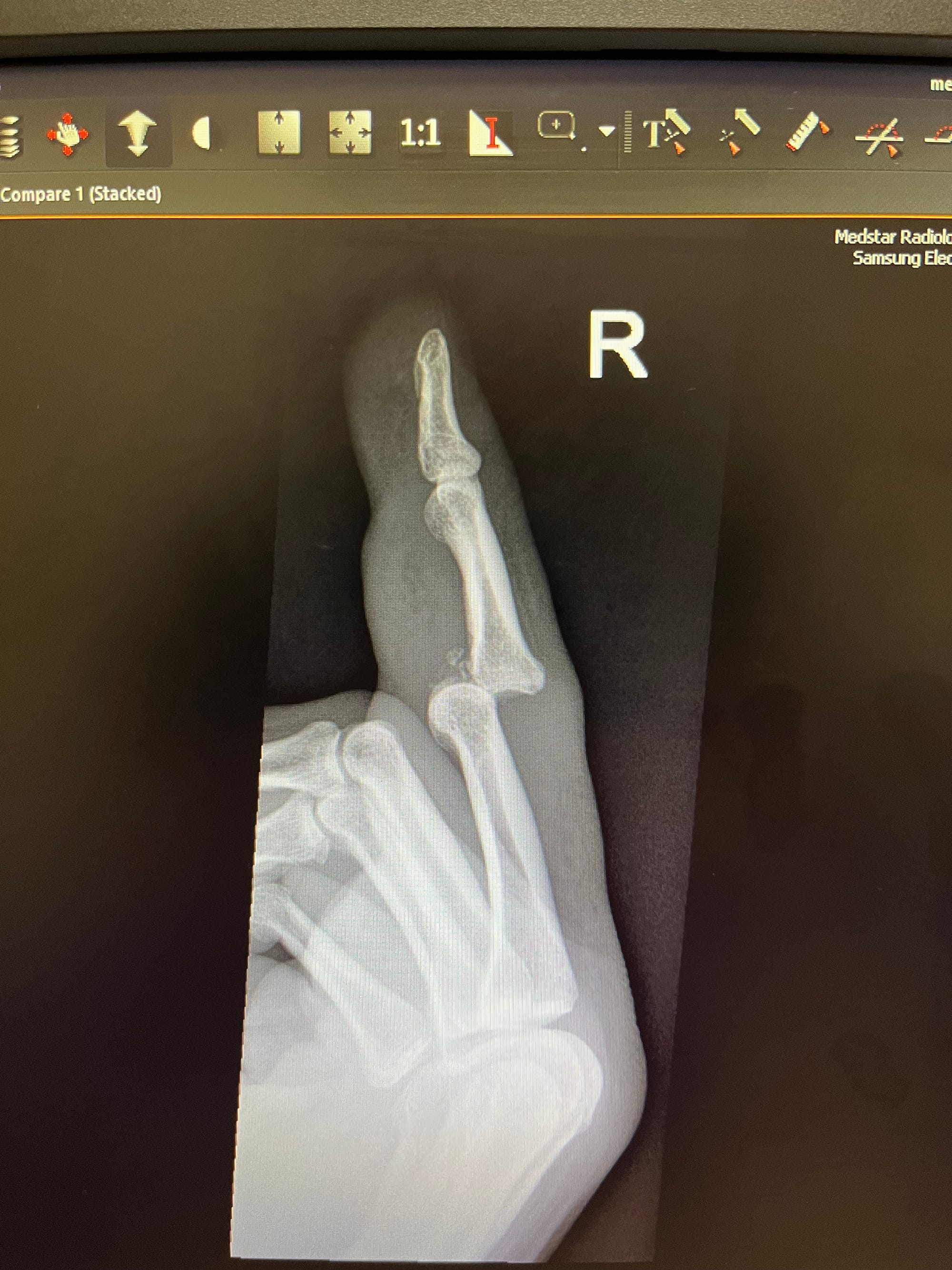 X-ray image of Frank’s broken middle finger.